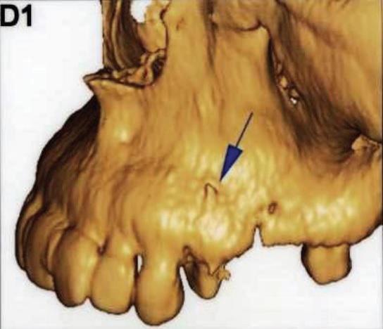 Ожог гипохлоритом натрия в стоматологии