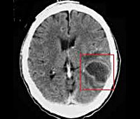 Отогенные внутричерепные осложнения Отогенные внутричерепные осложнения