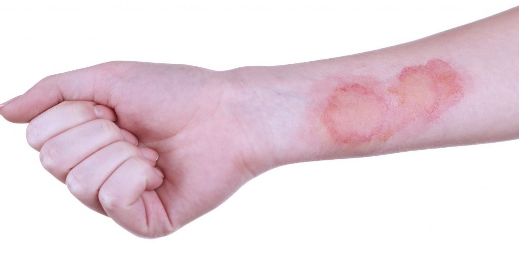 Что нужно делать когда получил ожог