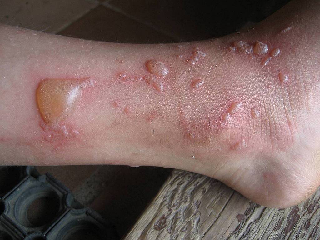 волдыри бывают белого, розового цвета