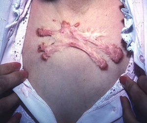 как избавиться от следа от ожога