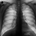 Какие признаки при затяжной пневмонии