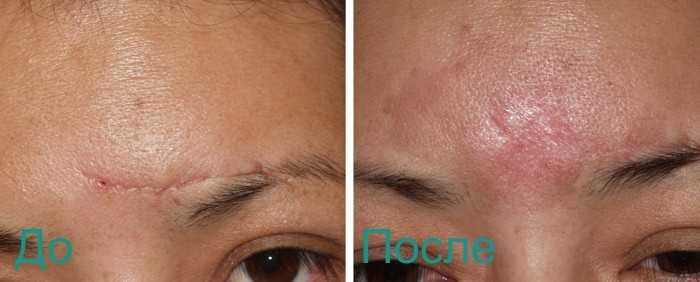 фото до и после лазерной шлифовки рубцов