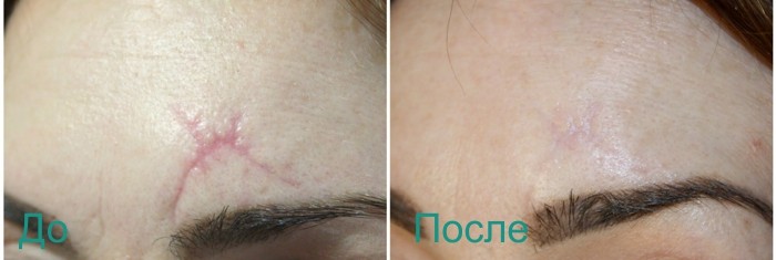 до и после лазерной шлифовки рубца на лице