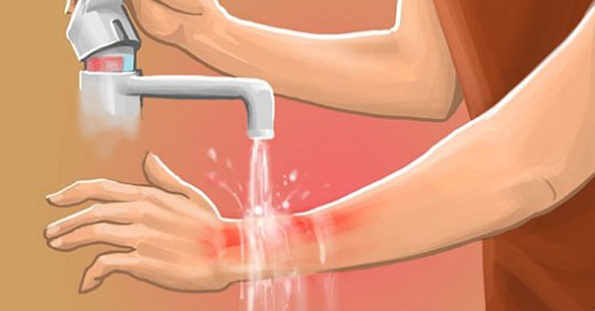 Первая медицинская помощь при ожогах классификация ожогов