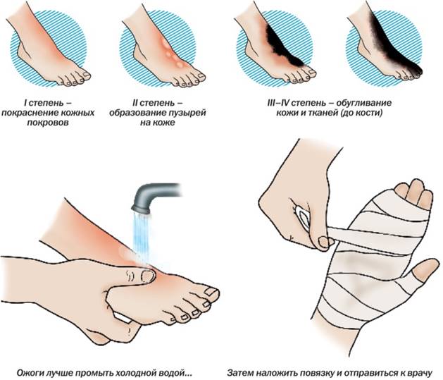 Первая медицинская помощь при ожогах классификация ожогов