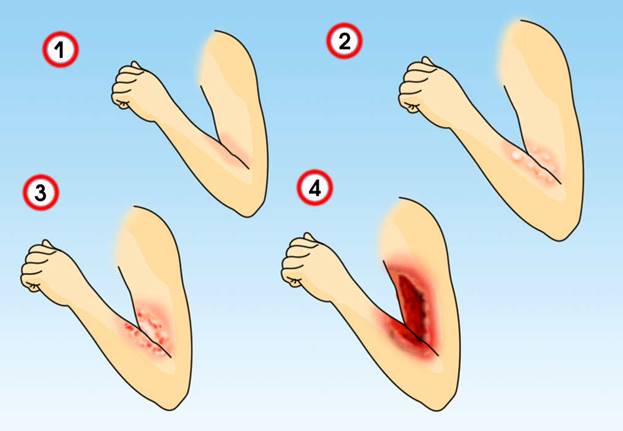 Первая медицинская помощь при ожогах классификация ожогов
