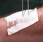 Первая медицинская помощь при ожогах классификация ожогов