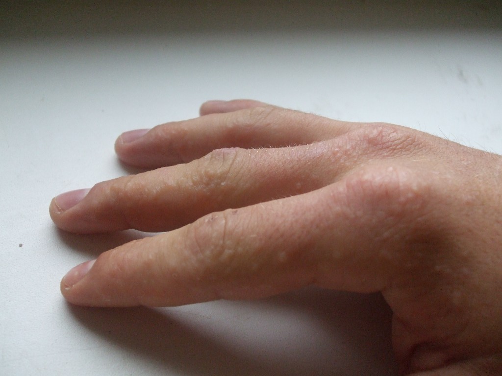 образования аллергической природы