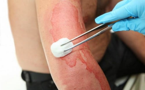 химический ожог