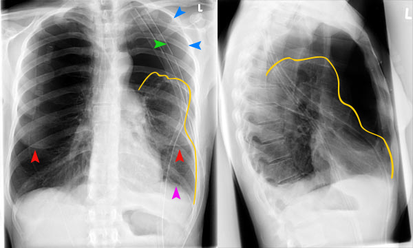 Что такое плевральной форме развития пневмонии