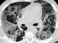 Интерстициальная пневмония симптомы у взрослых Интерстициальная пневмония симптомы у взрослых thumbnail