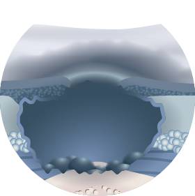 трофические язвы нижних конечностей лечебные повязки трофические язвы нижних конечностей лечебные повязки