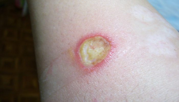 Чем мазать гнойную рану после ожога