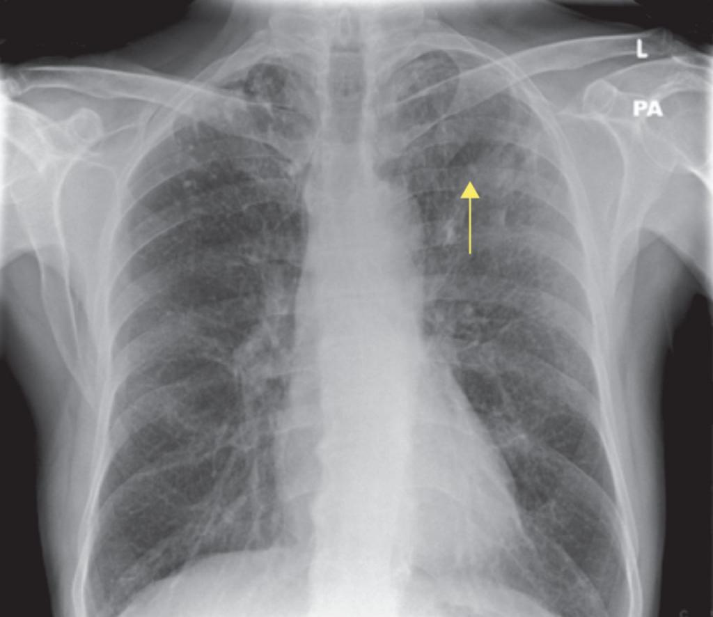 Очаговая пневмония фото
