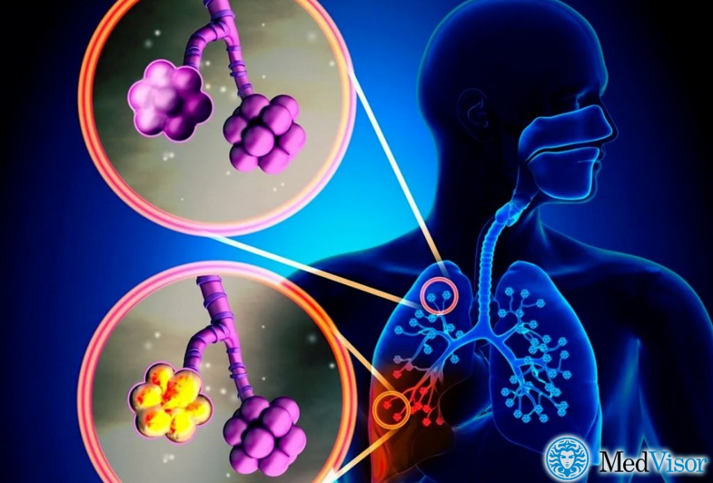 Пневмония без уточнения возбудителя Бронхит с пневмонией лечение у взрослых