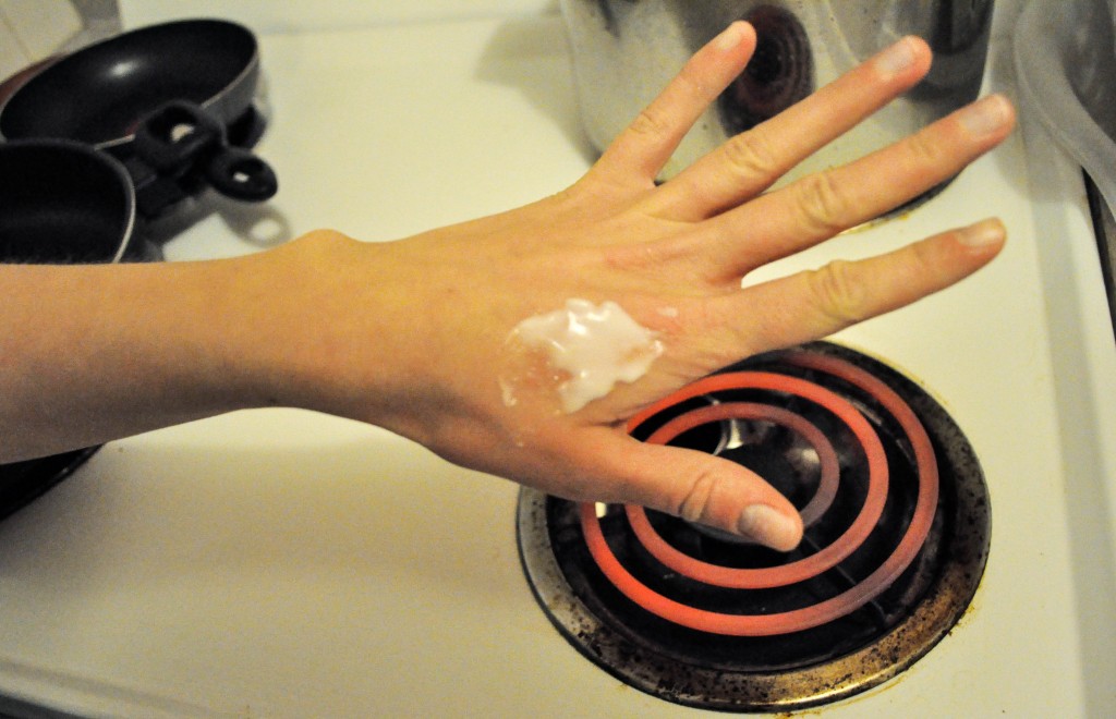 смазать ожог