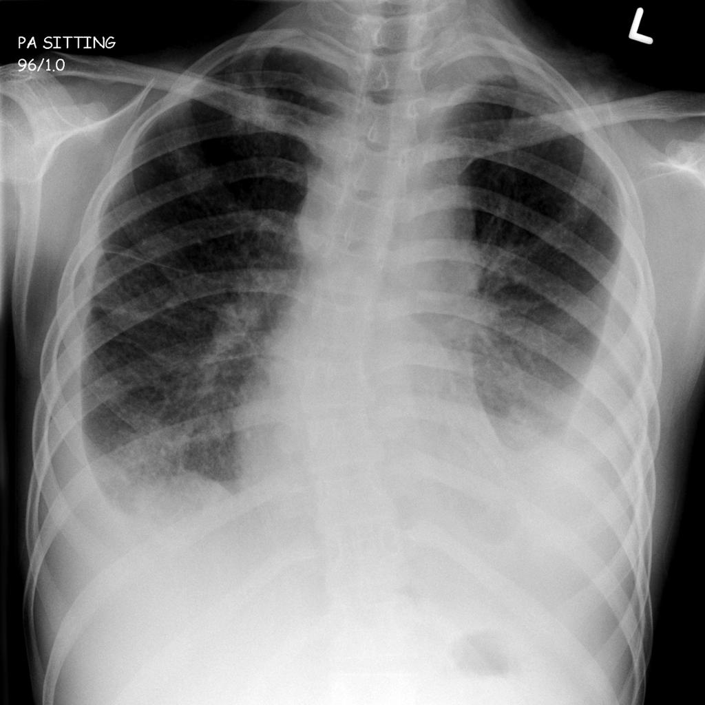 инфильтративный туберкулез