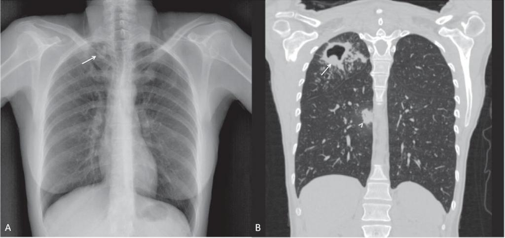 Кавернозный туберкулез