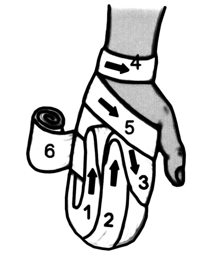 наложение повязки варежка