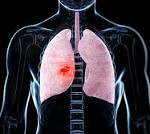 Затяжная пневмония Затяжная пневмония