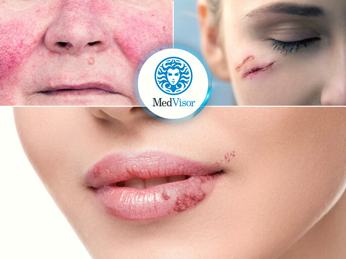 Противопоказания для пилинга Ожог от салициловой кислоты 2