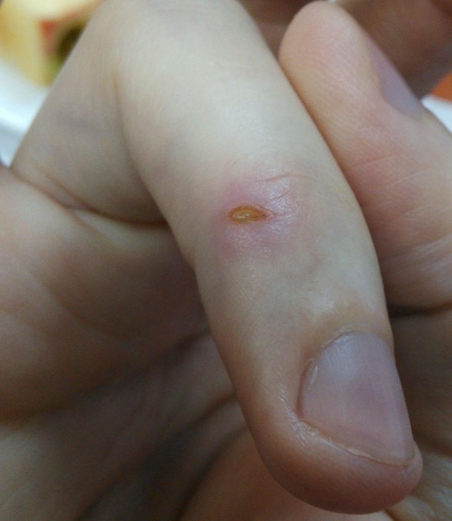 инфекционные волдыри