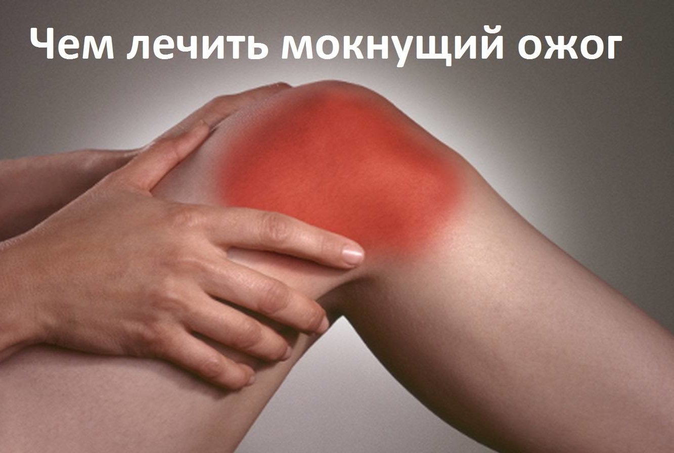 мокнущая рана после ожога чем лечить