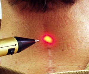 как убрать след от ожога на руке