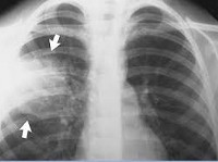 Пневмококковая пневмония