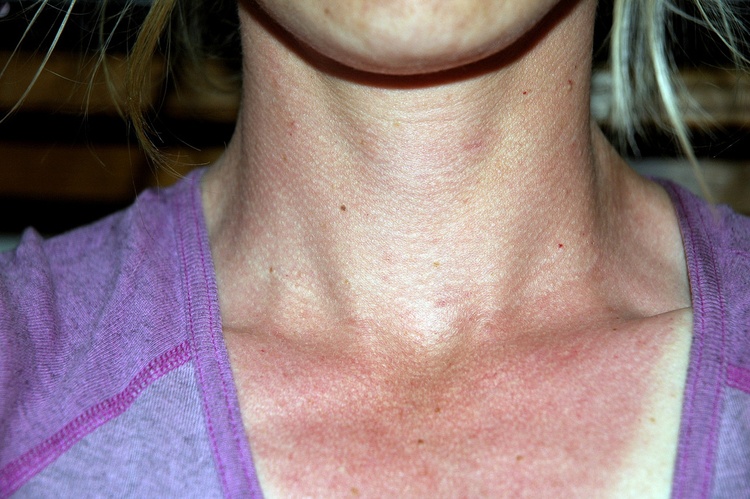 Чешется кожа при солнечный ожог