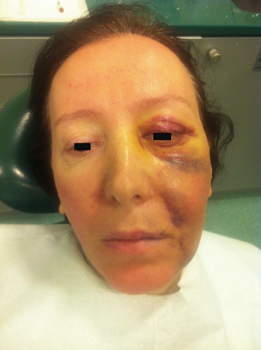 Ожог гипохлоритом натрия в стоматологии