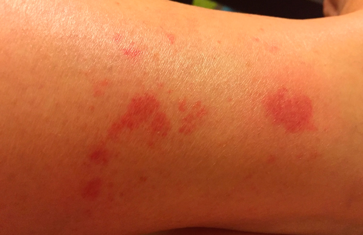 Мазь от солнечных ожогов спасатель