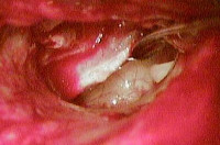 Хронический гнойный средний отит Хронический гнойный средний отит