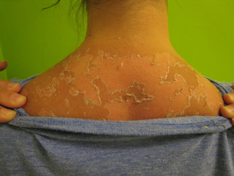 Мазь от пятна после ожога