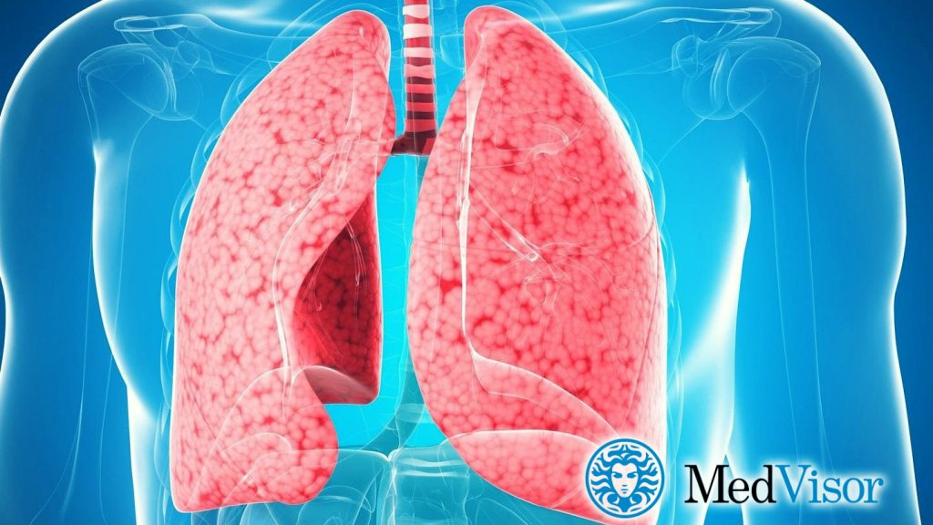 Может ли бронхит перейти в пневмонию? Бронхит с пневмонией лечение у взрослых