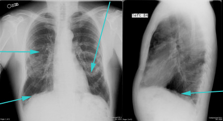 Что такое плевральной форме развития пневмонии