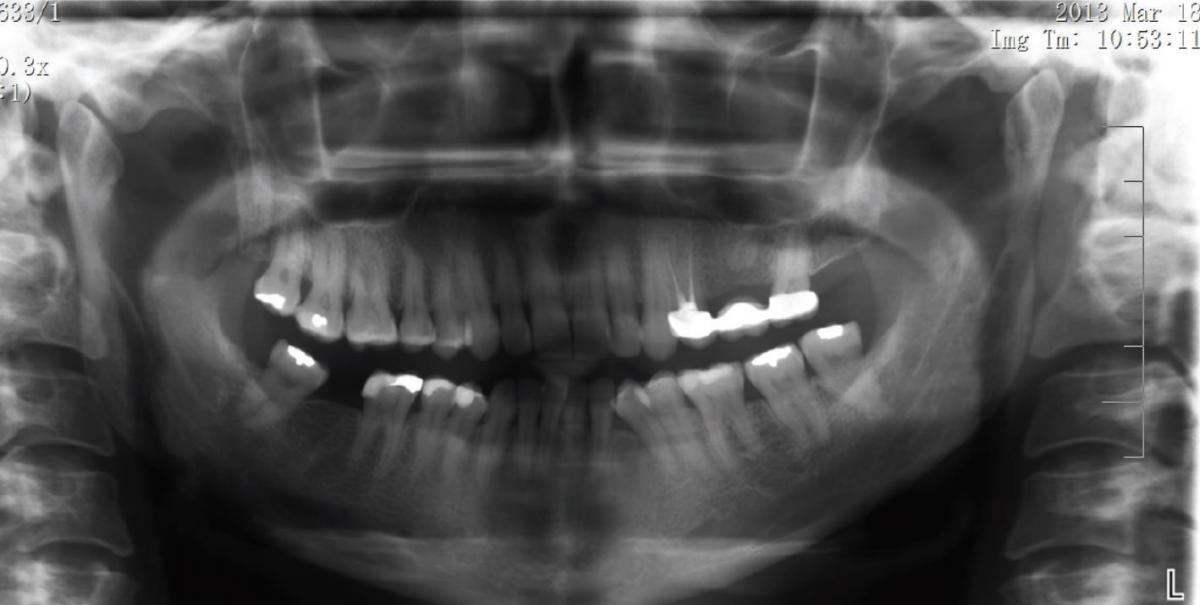 Ожог гипохлоритом натрия в стоматологии