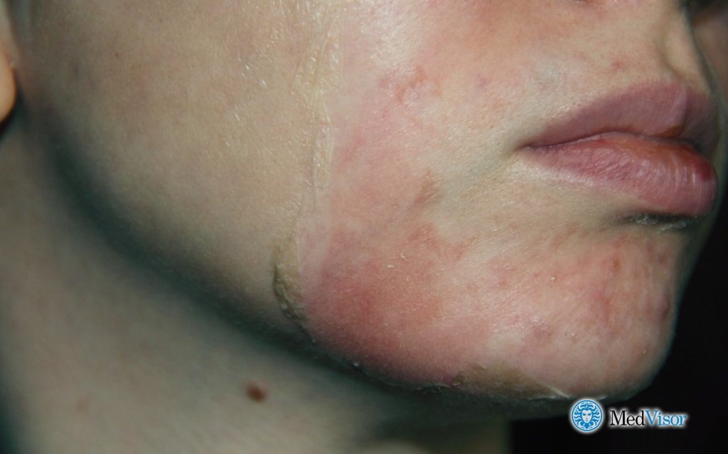 Ожог после салицилового пилинга фото Ожог от салициловой кислоты 2