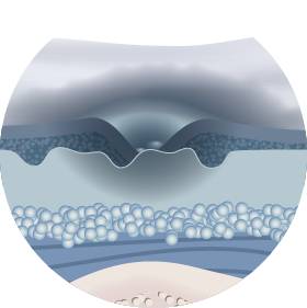 Пролежни 2 степени Пролежни 2 степени