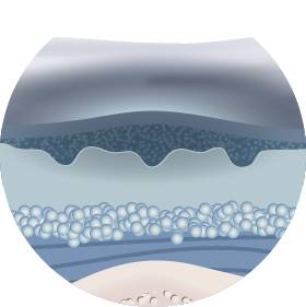 Пролежни 1-й стадии Пролежни 1-й стадии