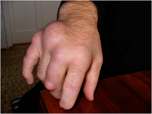 Диета-при-подагре-на-руках Диета при подагре пальцев рук