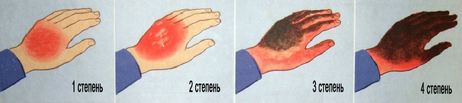 Что нужно делать если ожог палец Что нужно делать если ожог палец thumbnail