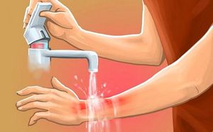 Чем мазать при ожоге утюгом в домашних условиях