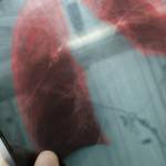 Какие признаки при затяжной пневмонии