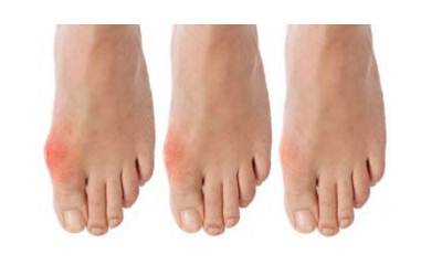 Подагра на ногах