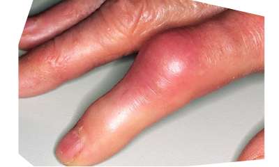 Подагра на пальцах рук