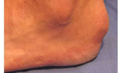 Подагра на пятке