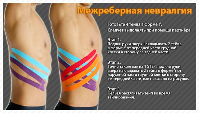 При реберной невралгии возникает колющаяся боль