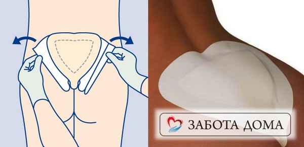 Противовоспалительные мази и повязки: Гидрокол, Гидросорб. Повязки для крестцовой области имеют обычно форму бабочки. Повзка бабочка